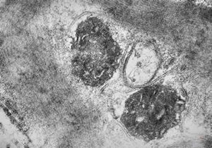 F,25y. | metachromatic leukodystrophy - n.suralis F,25y. | metachromatic leukodystrophy - n.suralis